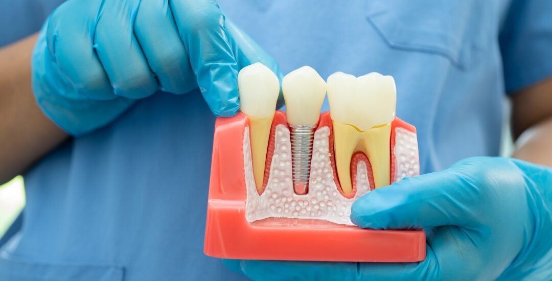 How Much Do Dental Implants Cost?