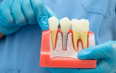 How Much Do Dental Implants Cost?